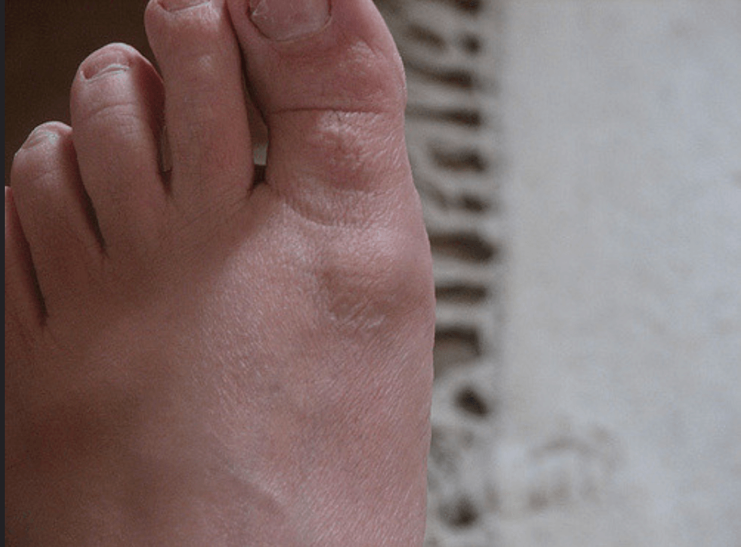 bone growth on top of foot